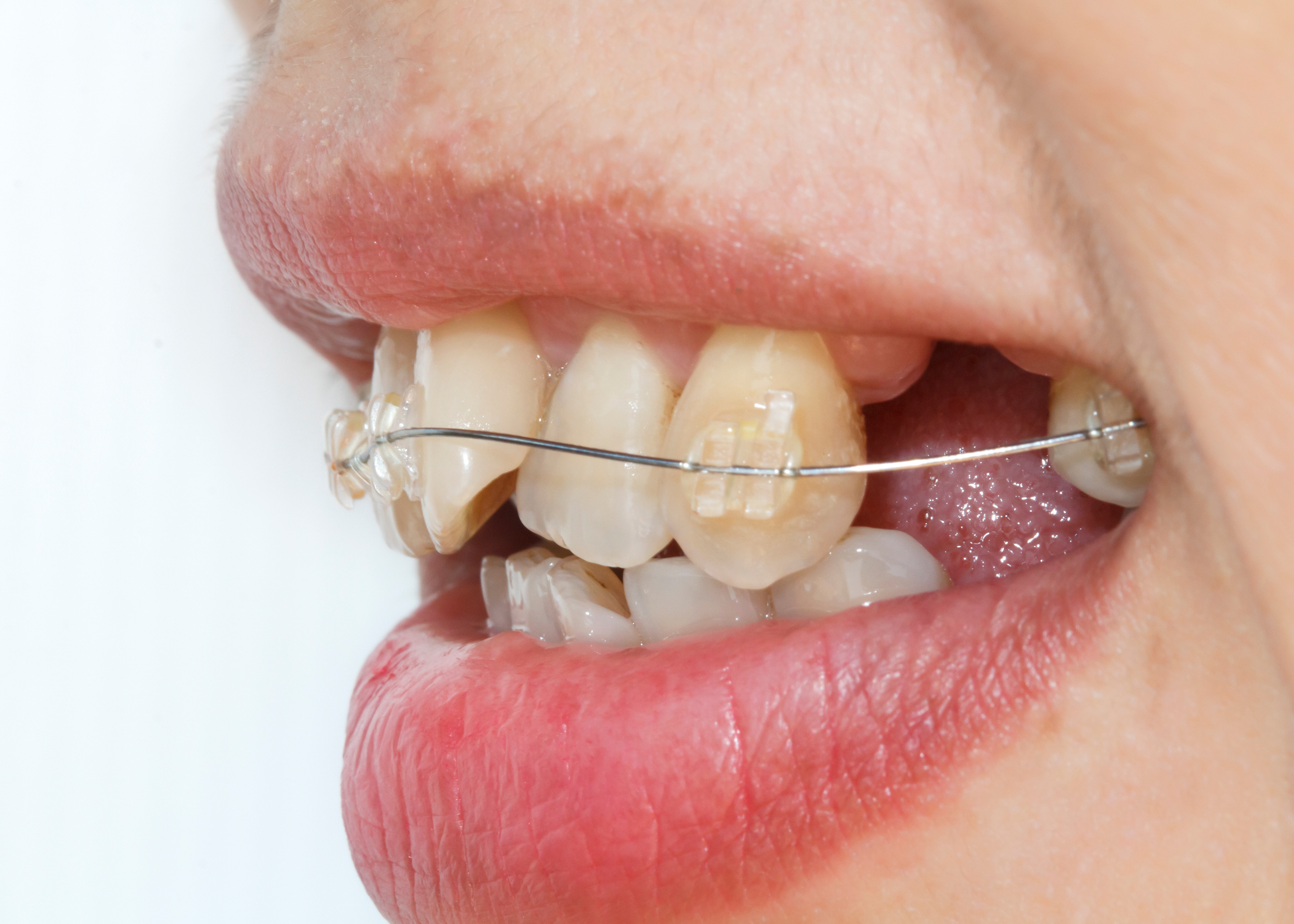 Dental and Orthodontic Concerns — Spot On Orofacial Myology Clinic